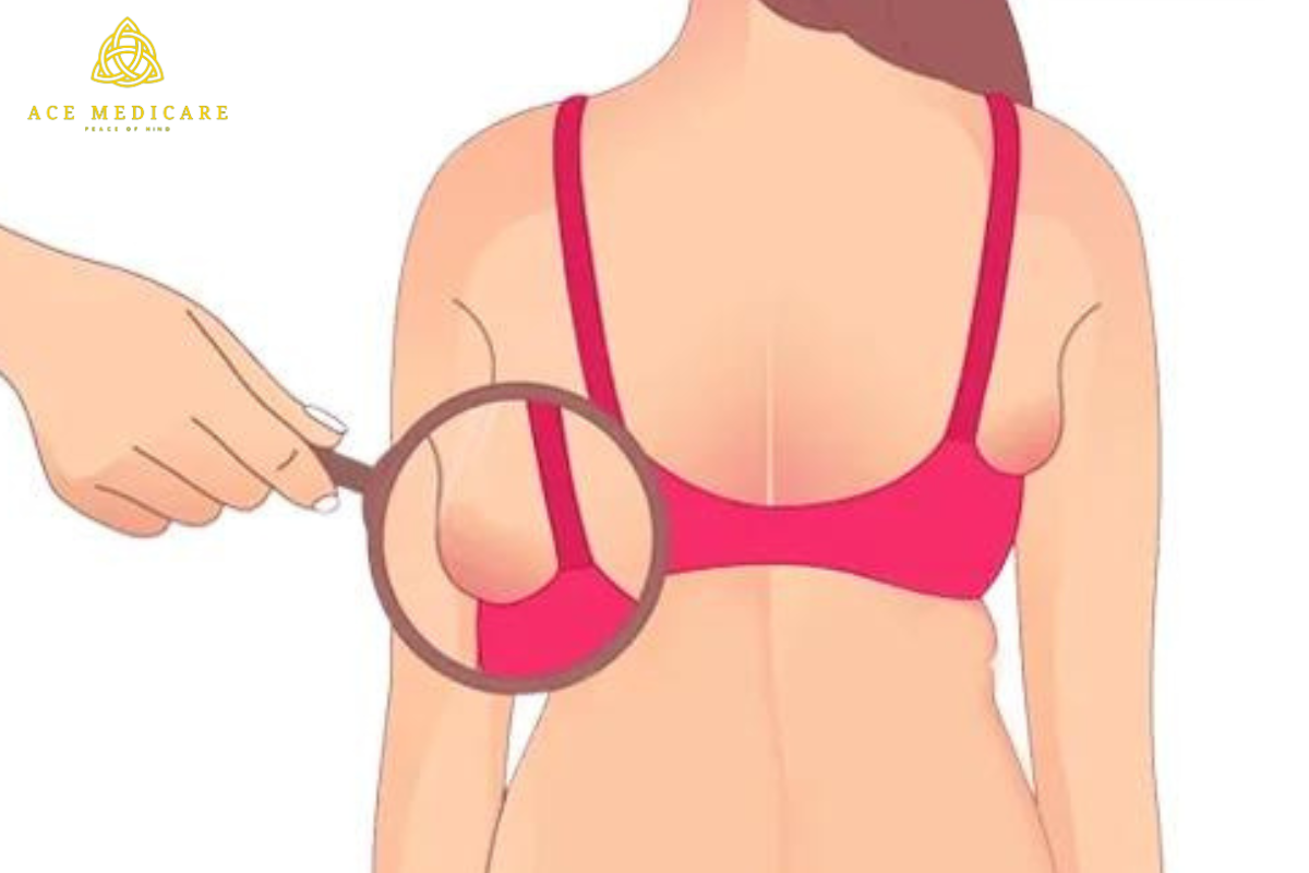 Managing Discomfort: Tips for Dealing with Axillary Breast Tissue
